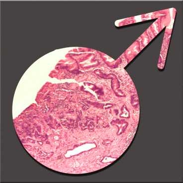 Cancerous lesions of the stomach lining, seen here, occur far more often in men than in women. MIT researchers say that discrepancy is due to the protective effects of estrogen during chronic H. pylori infection.