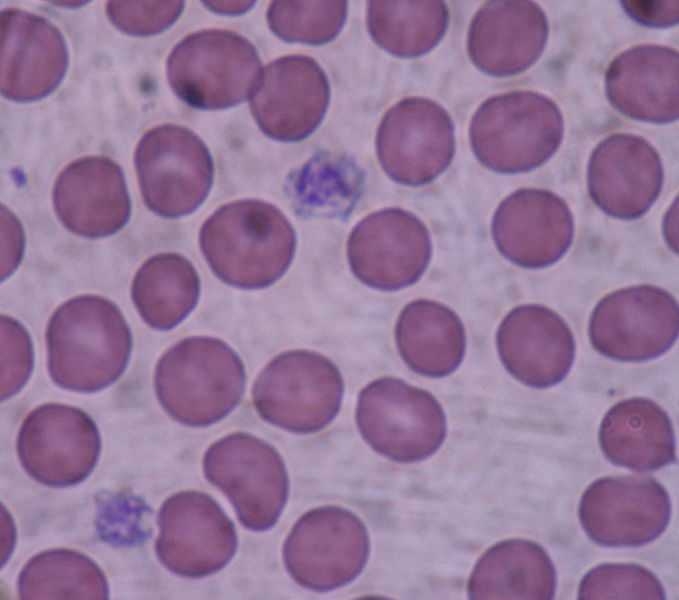 Giant platelets are shown here on a blood smear.