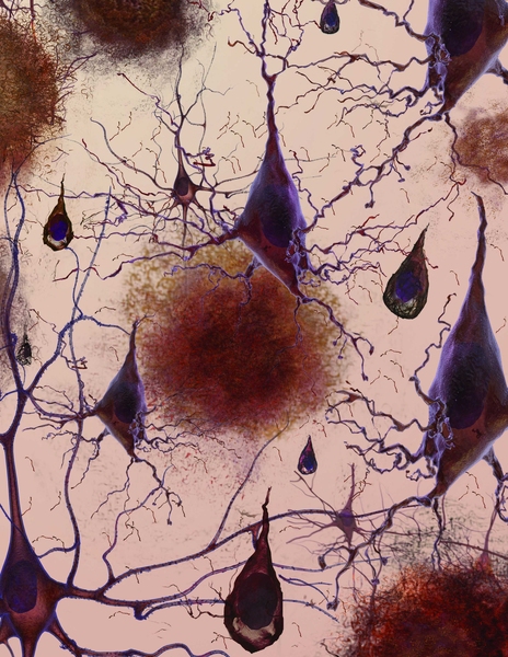 An artist's rendering of the loss of connections between neuron cells.