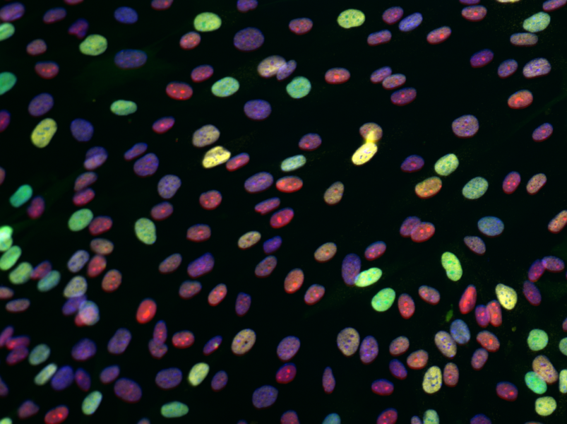 Differential cell responses to chemotherapy treatment. The photo shows a range of responses of similar cells to the chemotherapeutic drug doxorubicin. The most intensely responding drugs are shown in yellow, many of which will die. Green cells are alive but not dividing. Red cells are continuing to grow and divide. Yaffe and colleagues have figured out how to increase the proprotion of triple nega...