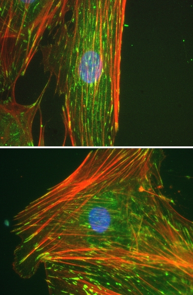 Proteins (actin, red and vinculin, green) inside adult bone marrow-derived stem cells that were grown in the lab for three days, with (top image) and without (bottom) the 'crowder' particles. Cells grown with the crowders form neatly aligned structures, or matrices, outside the cell, which in turn align their internal actin networks; the structures both outside and inside the cells grown without t...