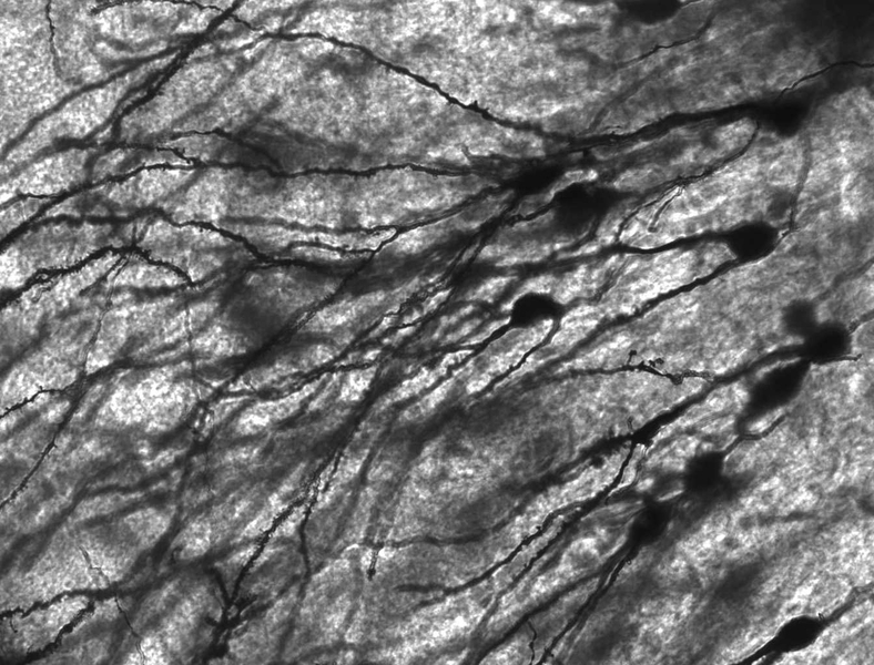 An image of Golgi stained neurons in the dentate gyrus of an epilepsy patient.