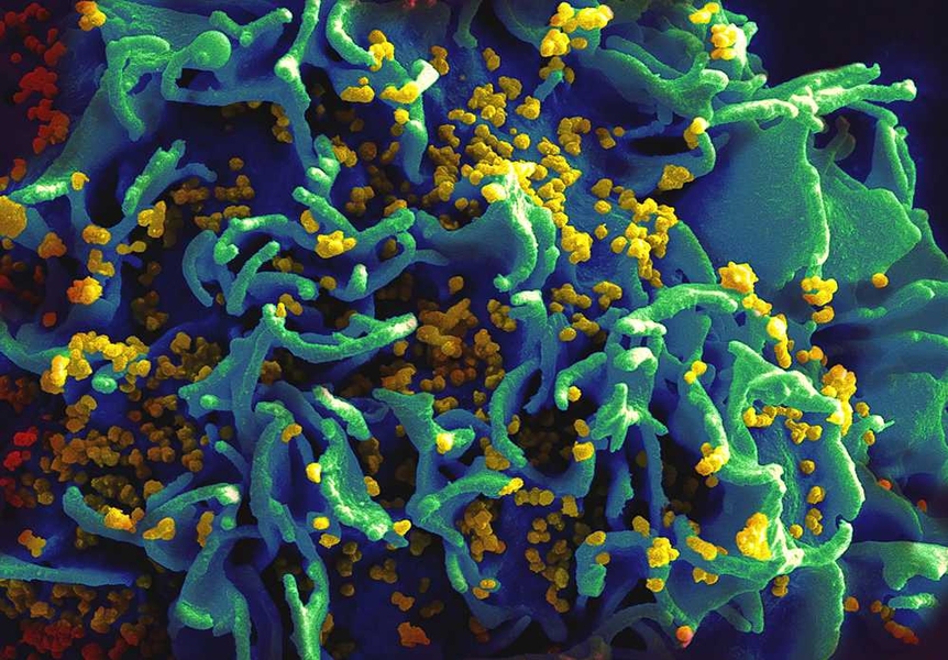 This scanning electron micrograph shows HIV particles infecting a human T cell.