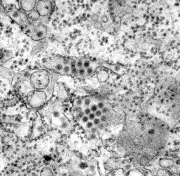 This transmission electron micrograph depicts a number of round, dengue virus particles that were revealed in a tissue specimen.