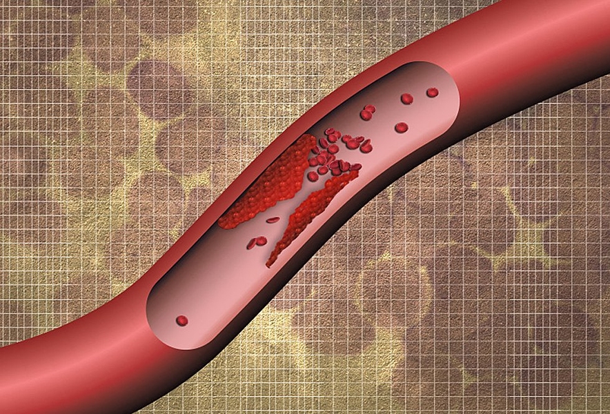 Finding blood clots before they wreak havoc, MIT News
