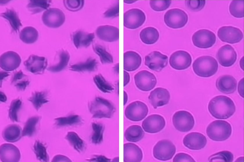 sickle cell vs normal cell