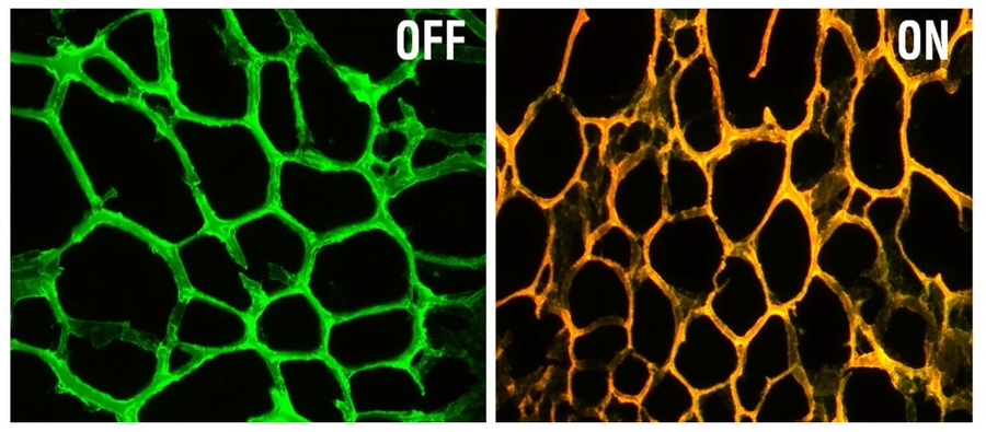 At left is the new nanodevice, consisting of a hydrogel embedded with gold nanoparticles coated with DNA targeting a gene called MRP-1. At right, the device fluoresces after encountering the target gene sequence.