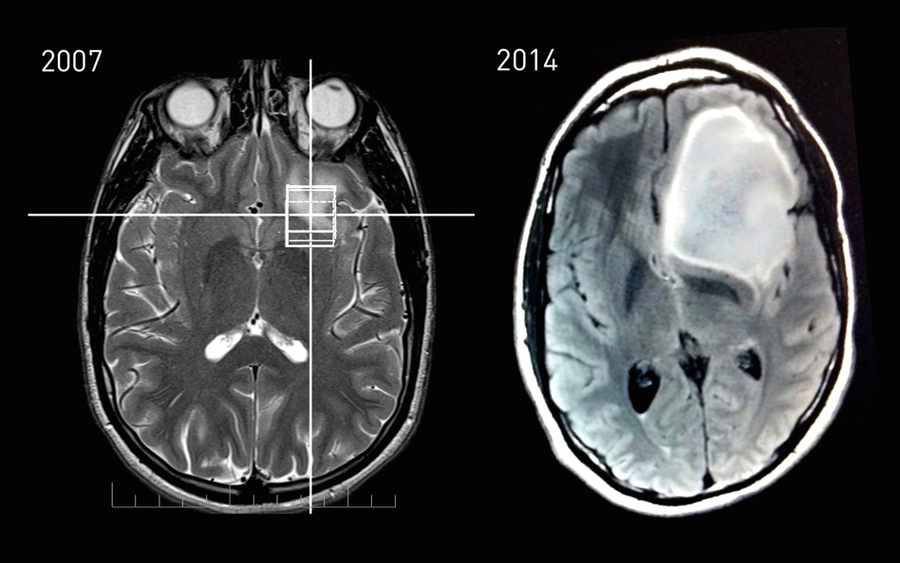 MRI data showing Keating’s astrocytoma tumor growth between 2007 and 2014.