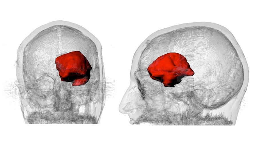 A 3-D visualization of Keating’s MRI data with the large astrocytoma tumor highlighted in red.