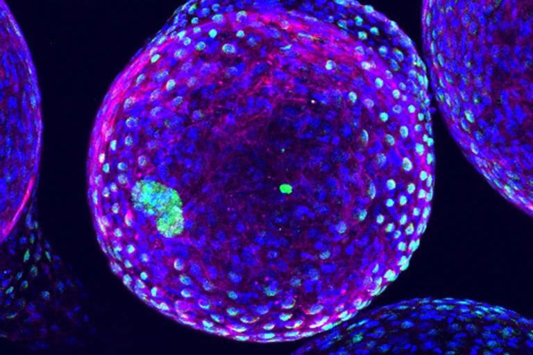 This image shows an artificial pancreas that could eliminate the routine of pinpricks and injections for type 1 diabetics. In this image, the body has recognized the artificial pancreas as foreign and fibrosis has built up on the device. The pancreatic islet cells are green and located inside the ball of alginate microcapsule. The blue and magenta are the host immune cells that have recognized the...
