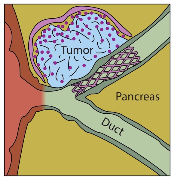 Can Pancreatic Cancer Be Cured With Chemotherapy?