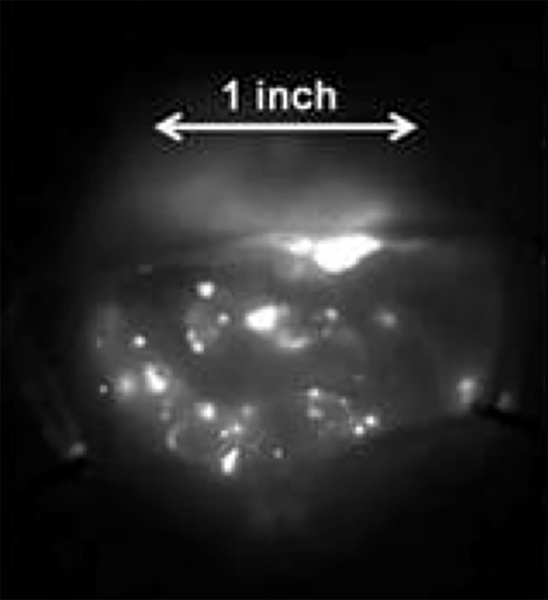 An NIR-II band near-infrared fluorescence image of cancerous tissue. The "glowing" regions have single-walled carbon nanotube probes attached, showing precisely where the tumors are.