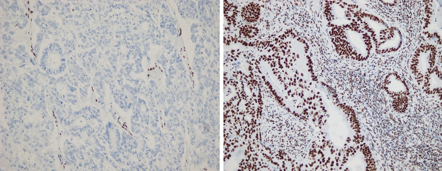 MIT researchers discovered that certain genes in endometrial cancer are inactivated in only some parts of the tumor. Tumor suppressor ARID1A is expressed in the primary tumor (left, brown staining) but not in its paired metastasis (right).