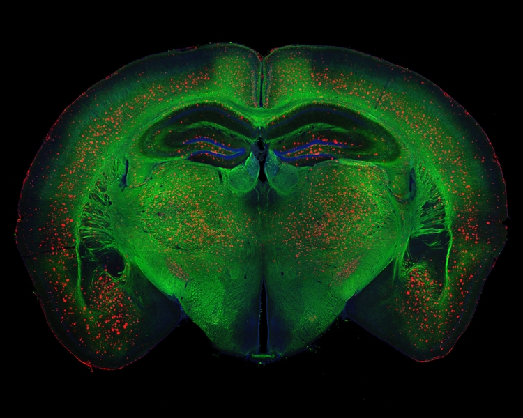 Beta-amyloid plaque deposits (red) disrupt mylelin (green) organization in the brain and activate microglia (orange), driving the inflammation, neurodegeneration, and cognitive disfunction associated with Alzheimer's disease.