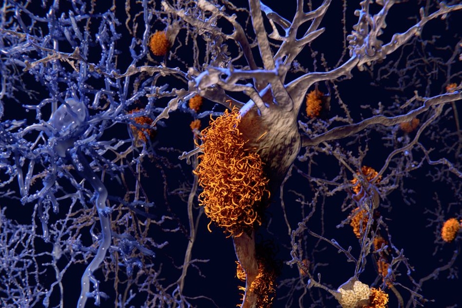 “Even though there has been a lot of high-resolution, atomic level structural work on amyloids by solid-state NMR, people have really not studied the metal-binding aspects,” says professor Mei Hong.
