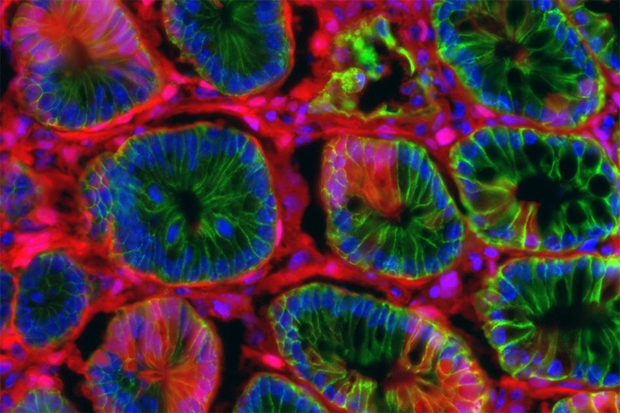 MIT researchers created this colon tumor by delivering RNA encapsulated in lipid nanoparticles to the colon. The RNA can activate or delete specific genes, leading to tumor growth.