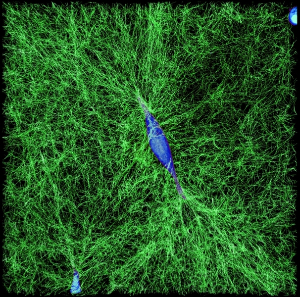 A human breast cancer cell (in blue) spreads in a 3-D collagen gel network (green). 