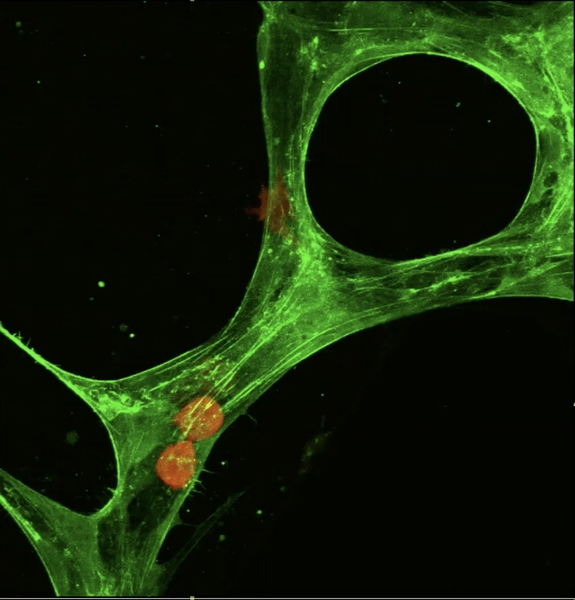 Using a 3-D vascularized network constructed in a microfluidic device, researchers capture the moment of extravasation — when a tumor cell (in red) leaves the blood stream (in green) and becomes metastatic.