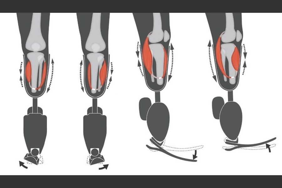 Prosthetics Artificial Limbs Manufacturers