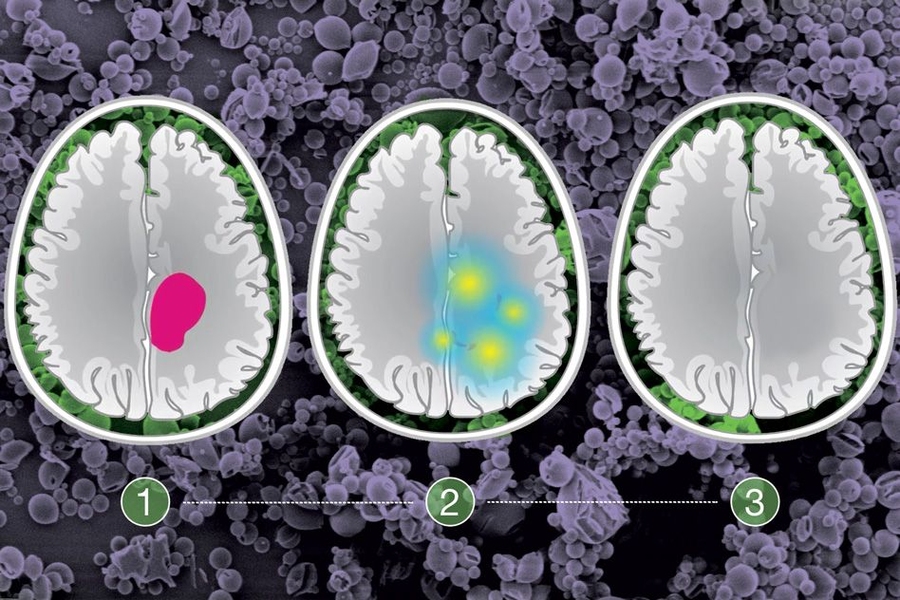 A targeted approach to treating glioma | MIT News | Massachusetts ...