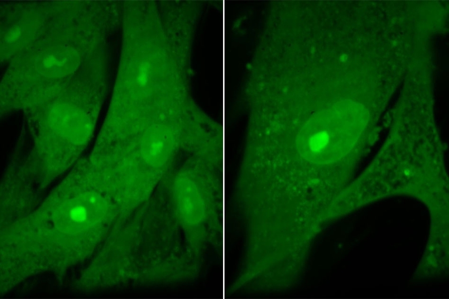 MIT researchers found that when they halted cell division in human fibroblast cells, they became abnormally large and then entered a non-dividing state known as senescence (right panel). Untreated, normal-sized fibroblasts are shown at left.