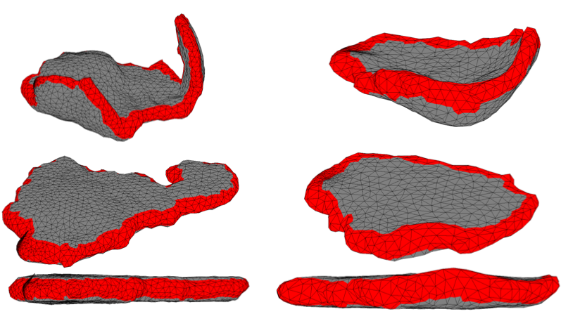 An algorithm developed at MIT takes MRI images of placentas (top) and flattens them to be more easily analyzed (middle and bottom).