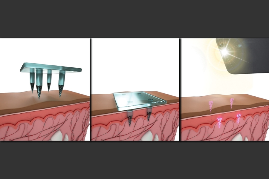 Illustration of patch with microneedles being applied to skin