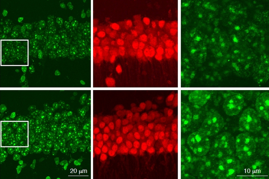 In this figure, neurons in the bottom row, which are missing the HDAC1 gene, show higher levels of DNA damage (green) than normal neurons.