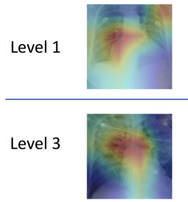 Images of level 1 versus level 3 pulmonary edema