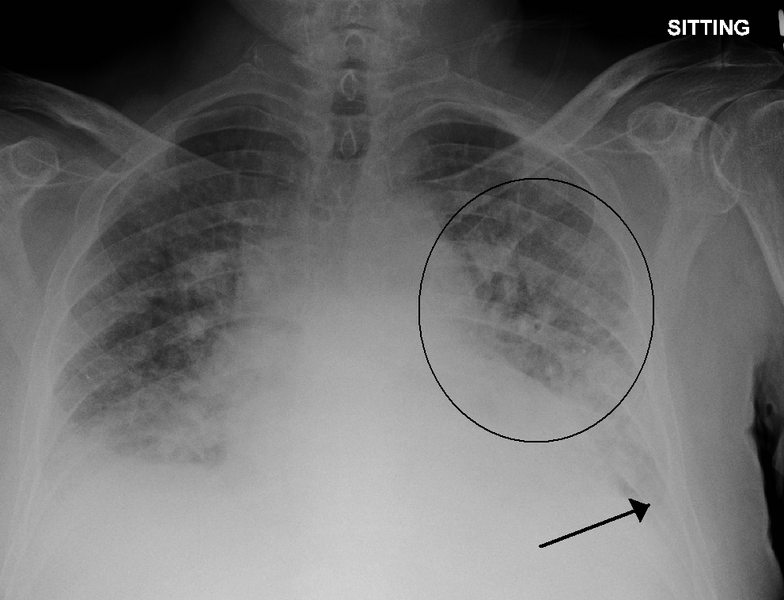 X-ray of a pulmonary edema