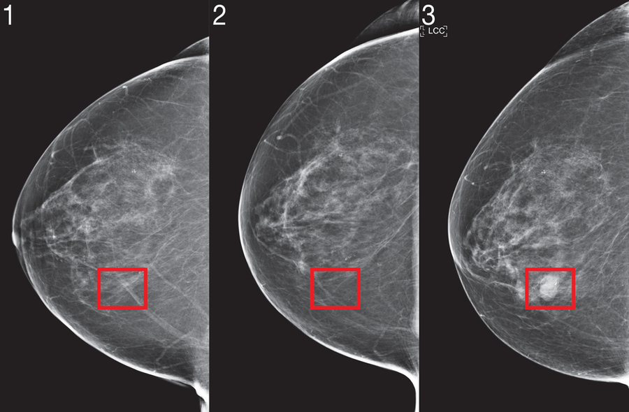 Three mammogram images, with a breast cancer lesion on the third slide