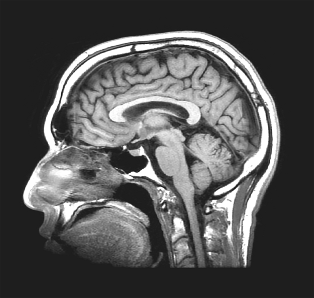 A greyscale image of a cross-section scan of a head, showing the brain