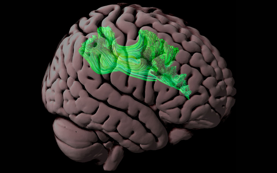 Image of human brain with white matter tracts highlighted in green