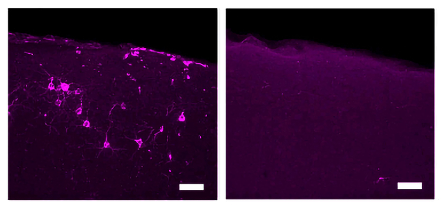 40 Hz vibrations reduce Alzheimer's pathology, symptoms in mouse