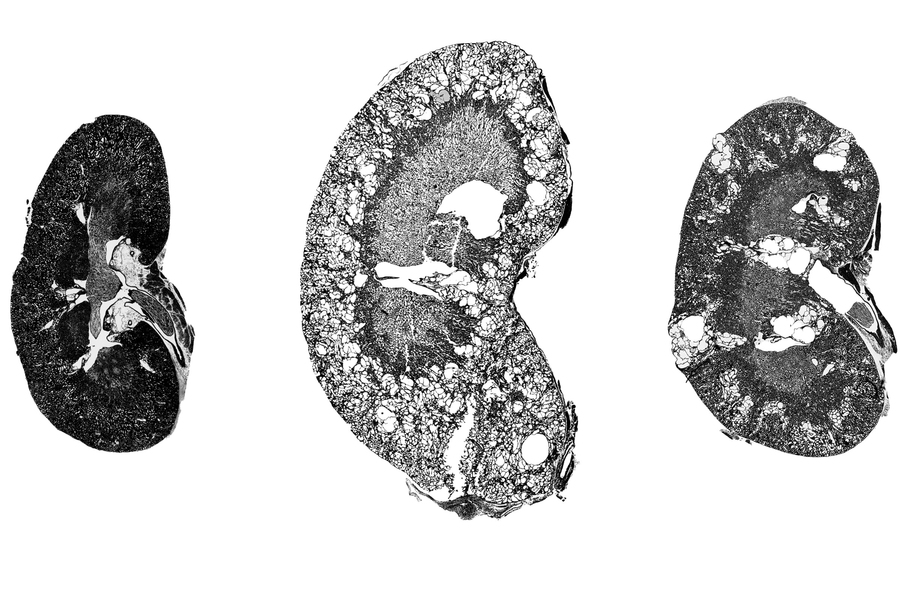 Black-and-white renderings of three kidneys, with the largest one in center
