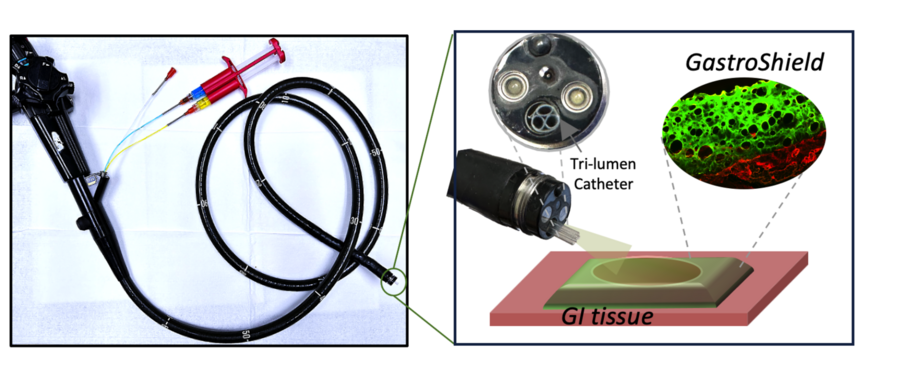 On left, a long endoscope has three syringes of materials going inside of it. On right, the end of the endoscope is enlarged showing the “tri-lumen catheter,” and the material is sprayed onto an illustration of GI tissue. A microscope image enlarges the GI tract, showing a green and red GI tract, labeled “GastroShield.”