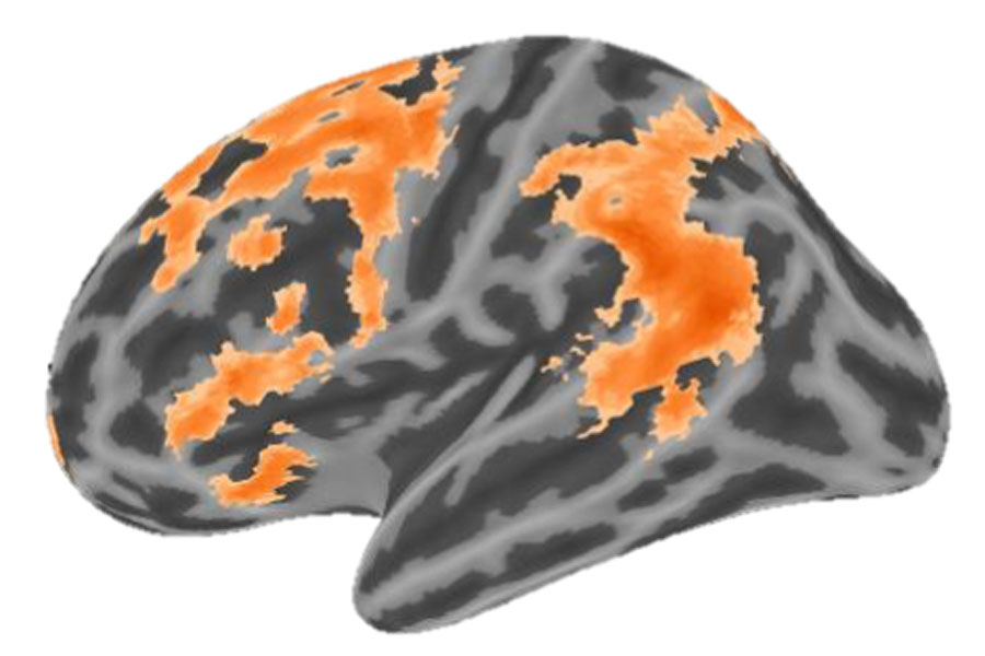 MRI image of brain with orange highlights in specific regions