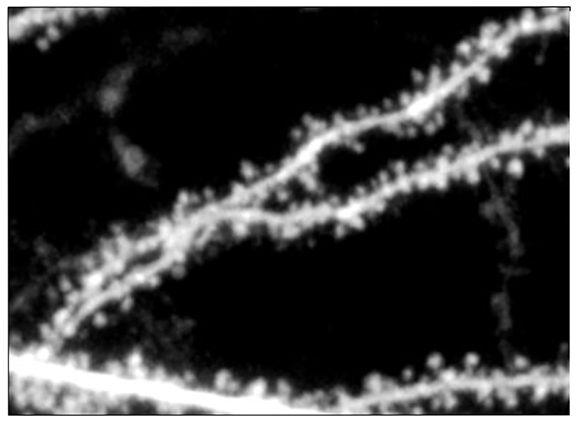 Study suggests new molecular strategy for treating fragile X