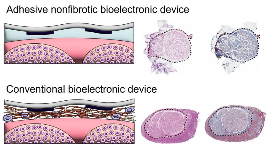 A graphic showing scar tissue formation around a conventional device and a new design with little scarring