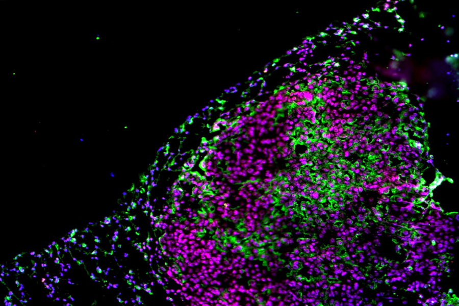 Microscopic view of lung tumor cells