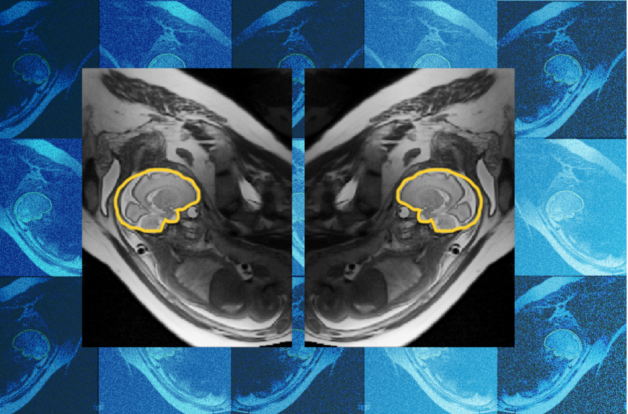Why teaching AI about symmetry could make prenatal diagnosis more ...