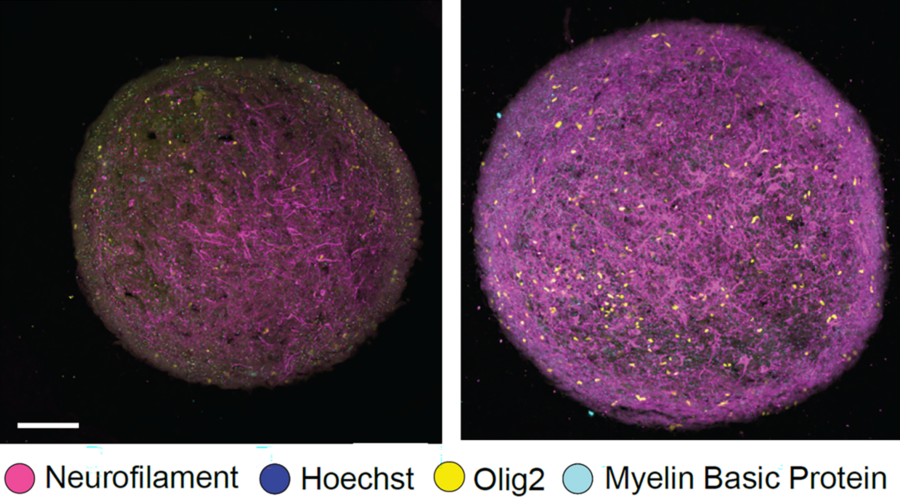 Two panels show spherical cerebral organoids, which appear as a dense tangle of magenta and cyan strands speckled with bright yellow dots. The one on the right has much more of the pink strands than the one on the left.