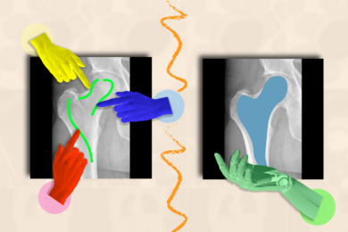 Illustration with (at left) 3 colorful human hands pointing to a scribble on an X-ray of a human hip. At right, a green robotic hand appears under the same region of the X-ray.