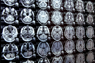 Multiple medical scans of a brain