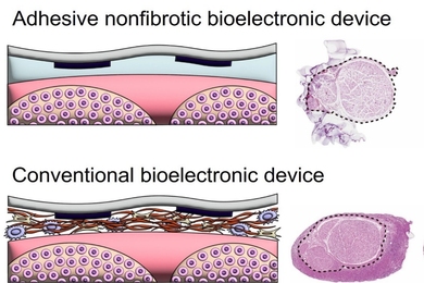 A graphic showing scar tissue formation around a conventional device and a new design with little scarring
