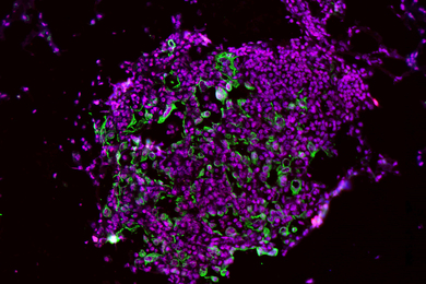 Microscopic view of lung tumor cells