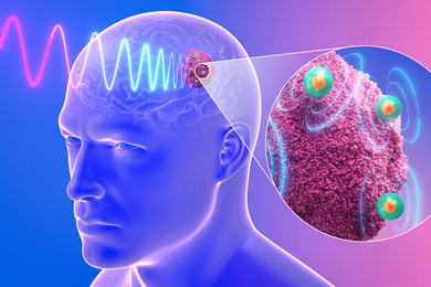 3D illustration of a translucent blue human head in profile with a visible brain; electromagnetic waves target a tumor site near the skull, while a circular inset magnifies green-and-orange nanoparticles emitting energy waves within pink tumor tissue.
