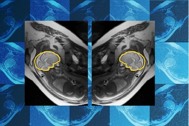 Greyscale fetal MRI showing two mirrored views of a fetus in the womb, with the fetal brain outlined in yellow in each image. A tiled blue background pattern of similar fetal brain scans is in the background