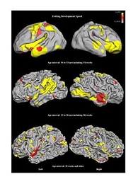 Larger-scale folds develop the fastest in premature (born more than seven weeks early) infants (top), while medium-scale folds develop the fastest in older premature infants, born between seven and two weeks early (middle). In older infants and children, fine folds develop the most quickly across the brain surface (bottom).