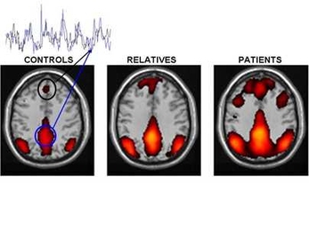 Altered brain connectivity of default brain network in persons with schizophrenia...